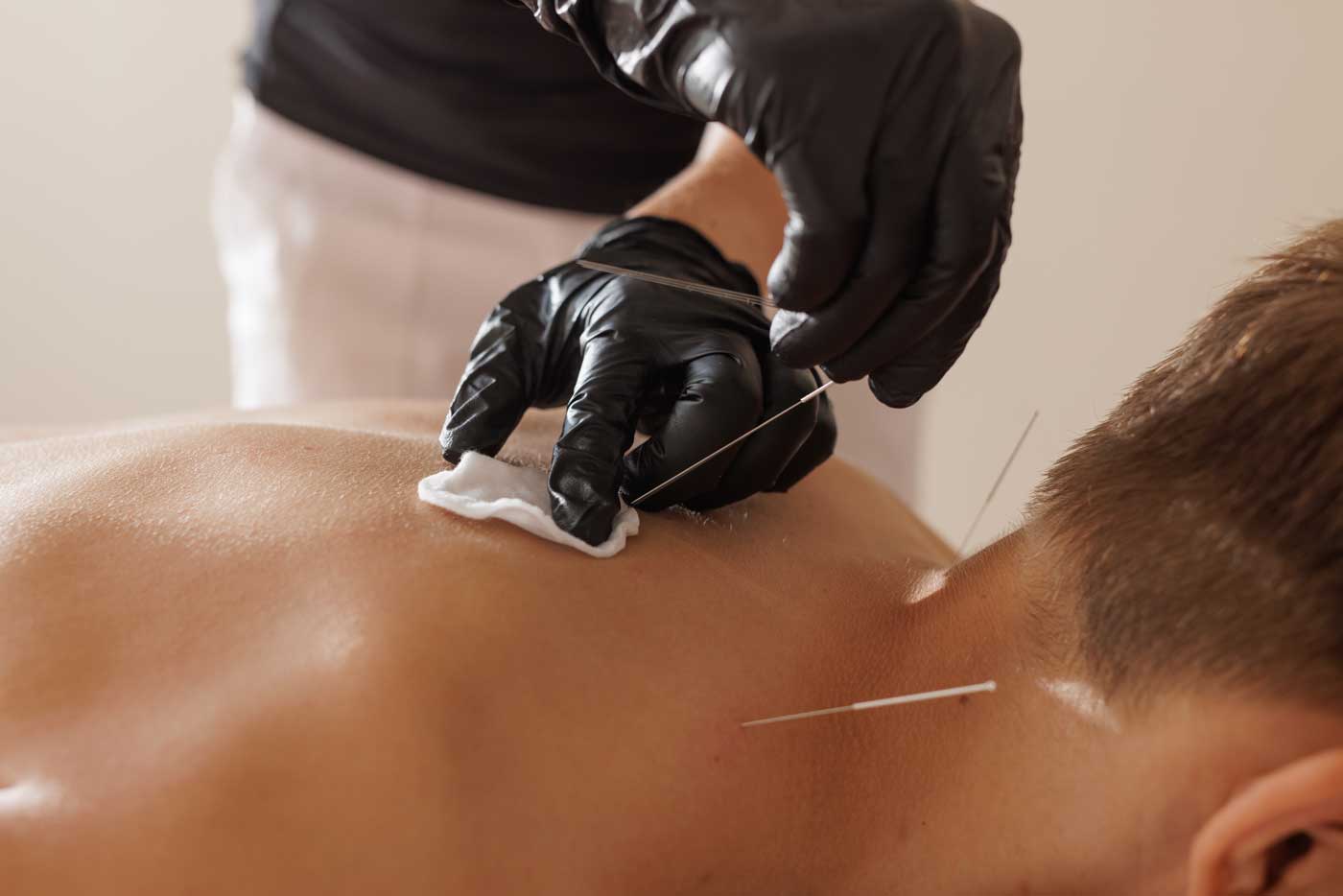 Dry Needling