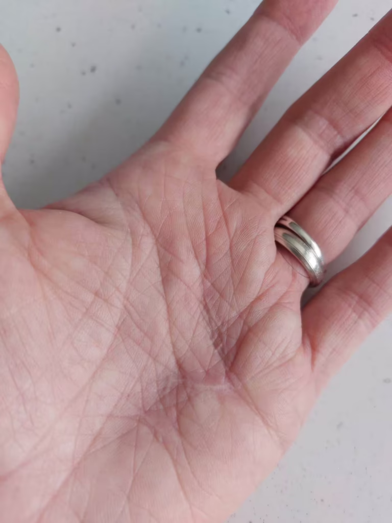Hand Scar after
