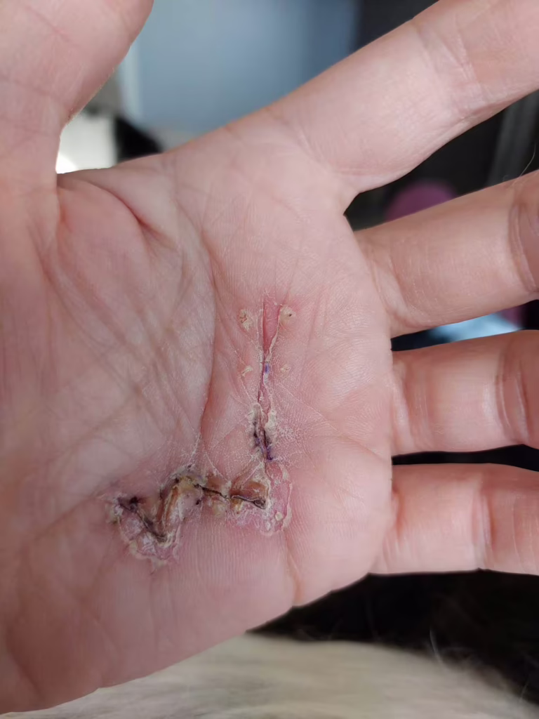 Hand Scar before